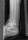 Contusion y Hematoma.JPG (973898 bytes)